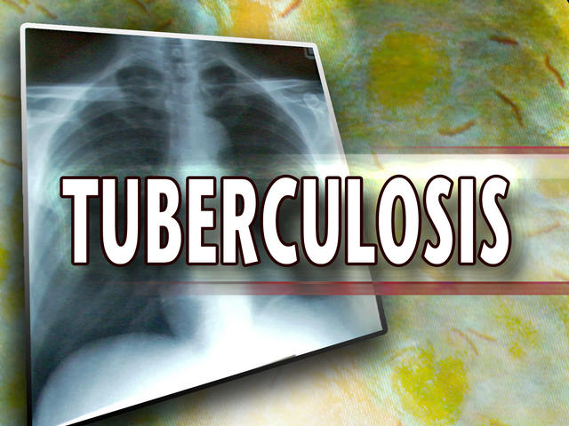 UDC Community College confirms TB exposure | wusa9.com